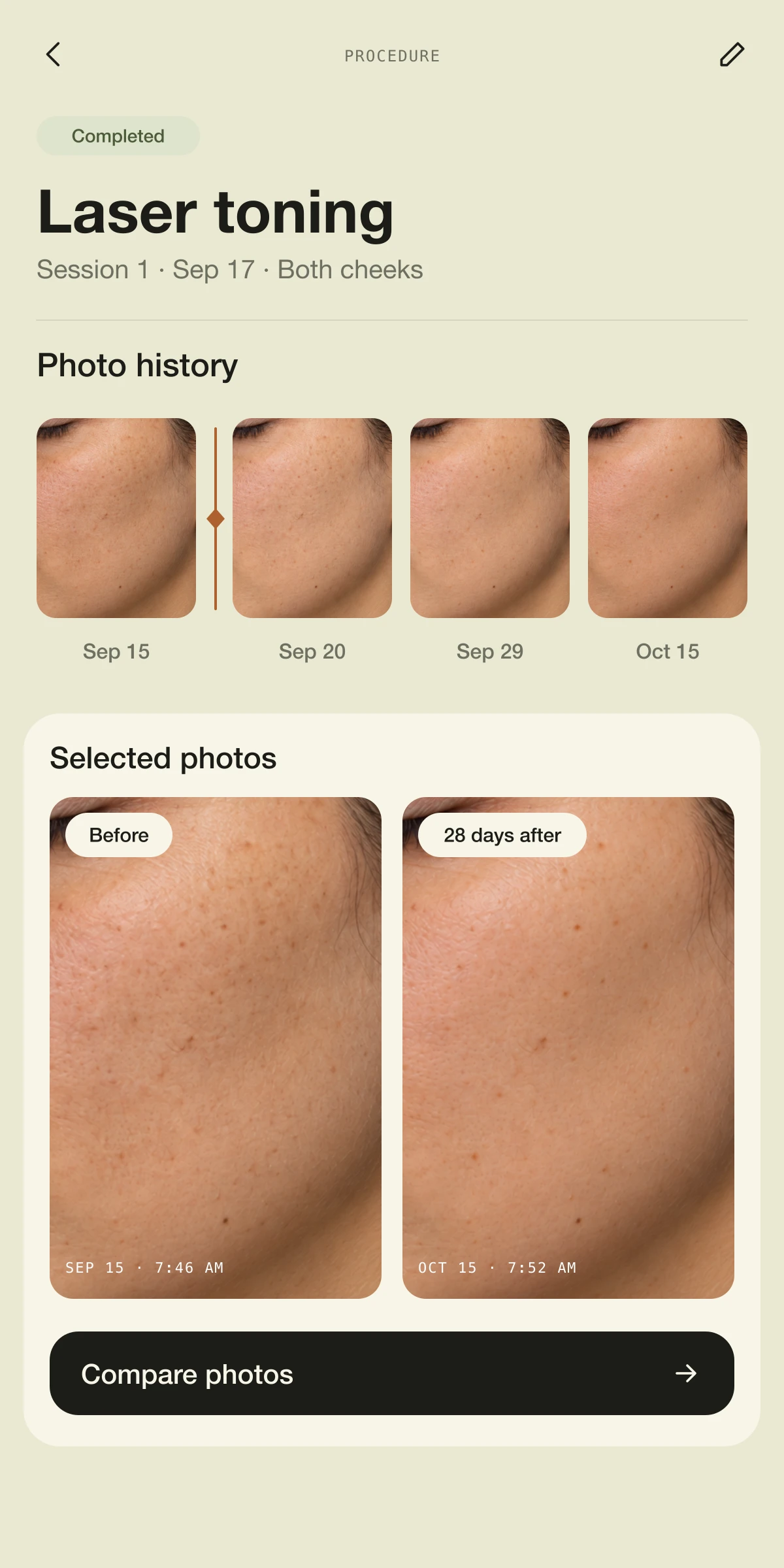 Procedure timeline with dated cheek photos.