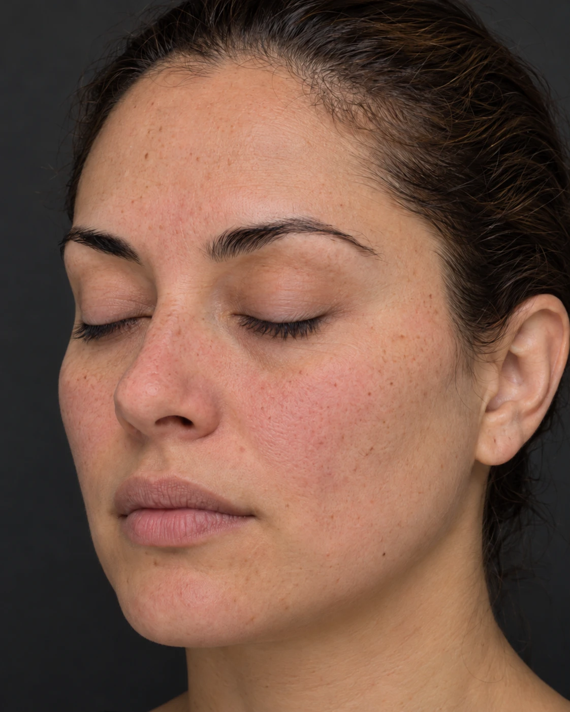 Skin photographed with cross polarized light